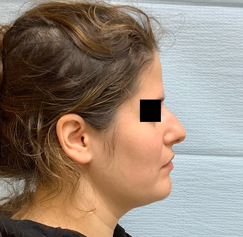 Rhinoplasty