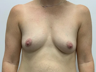 Breast Augmentation