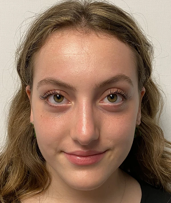 Rhinoplasty