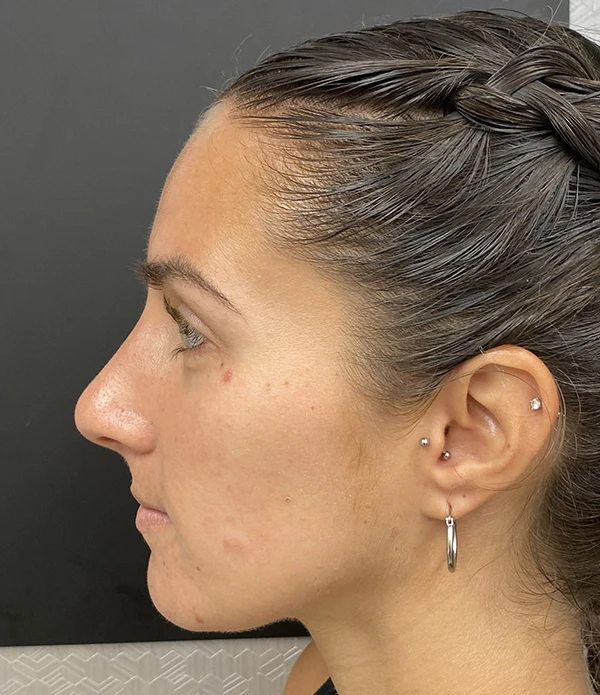 Rhinoplasty