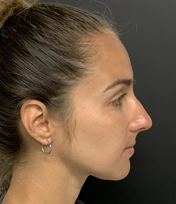 Rhinoplasty