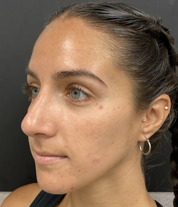 Rhinoplasty