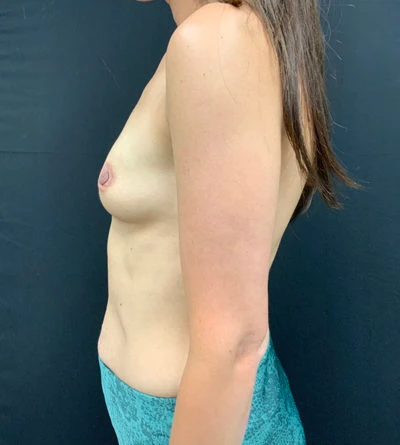 Breast Augmentation