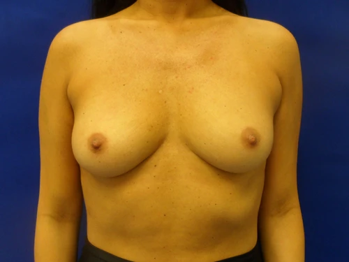 Breast Augmentation