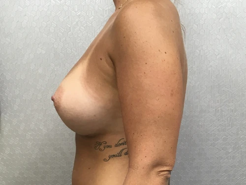 Breast Augmentation