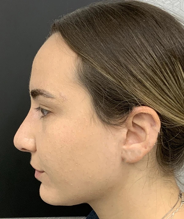 Rhinoplasty