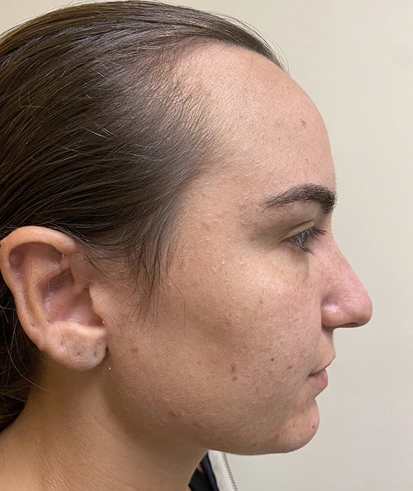 Rhinoplasty