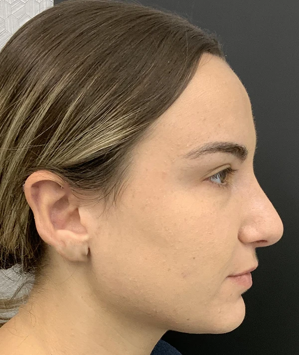 Rhinoplasty