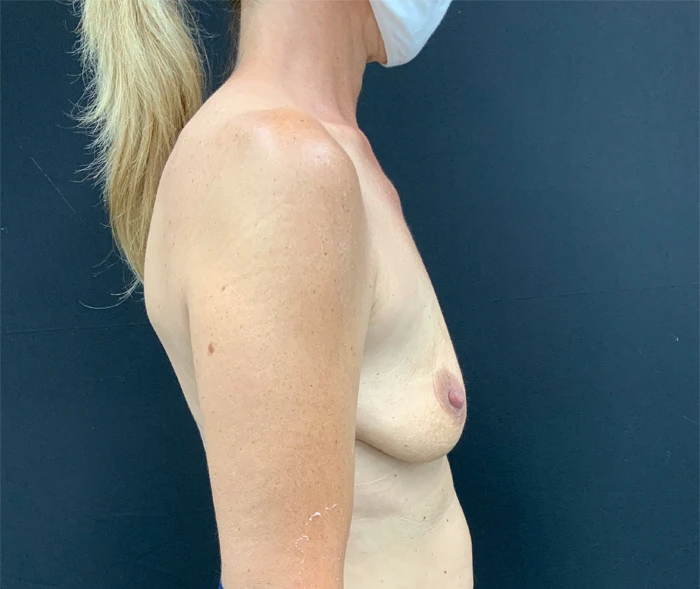 Breast Augmentation with Lift