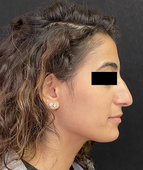 Rhinoplasty