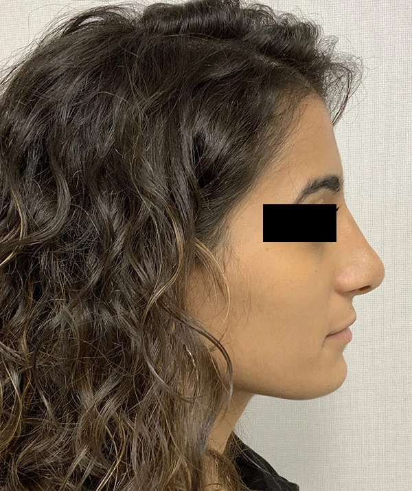 Rhinoplasty