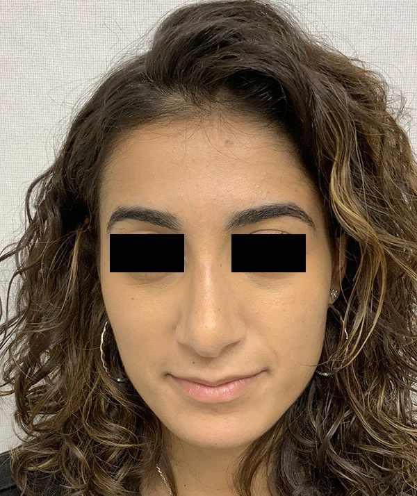 Rhinoplasty