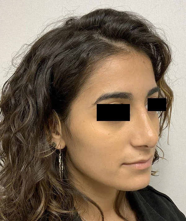 Rhinoplasty