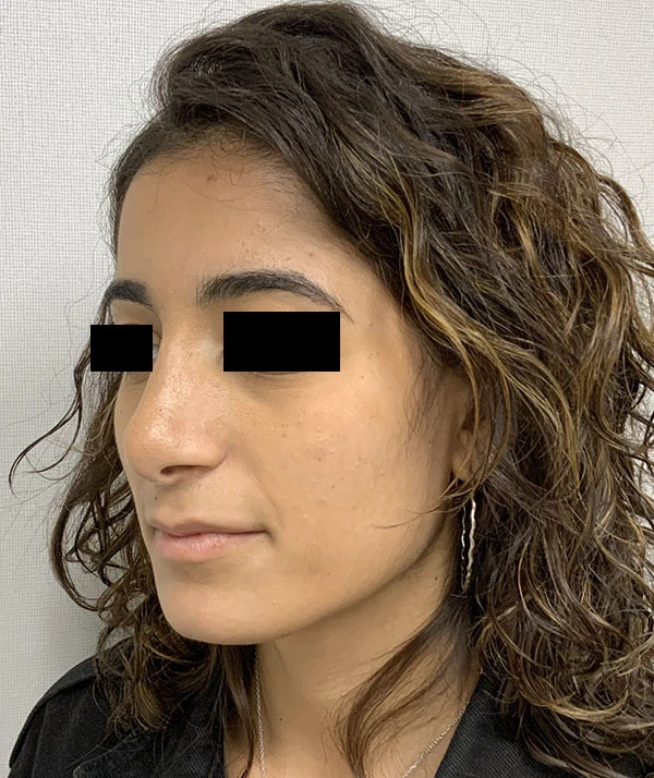 Rhinoplasty