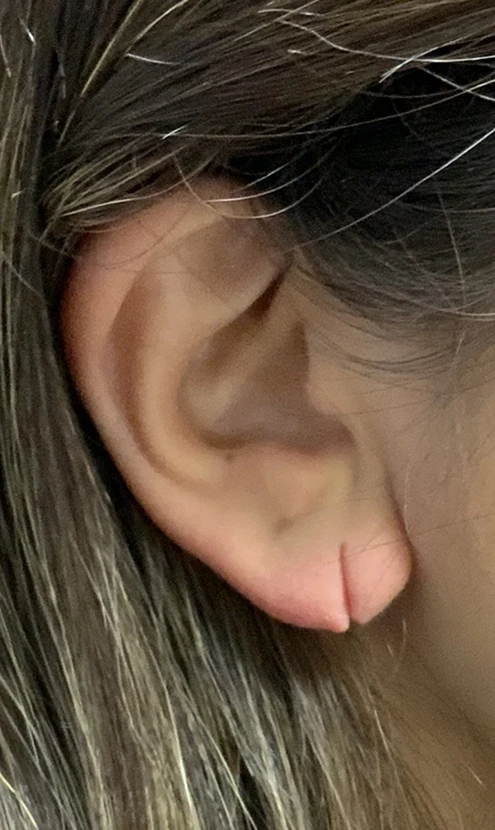 Earlobe Repair