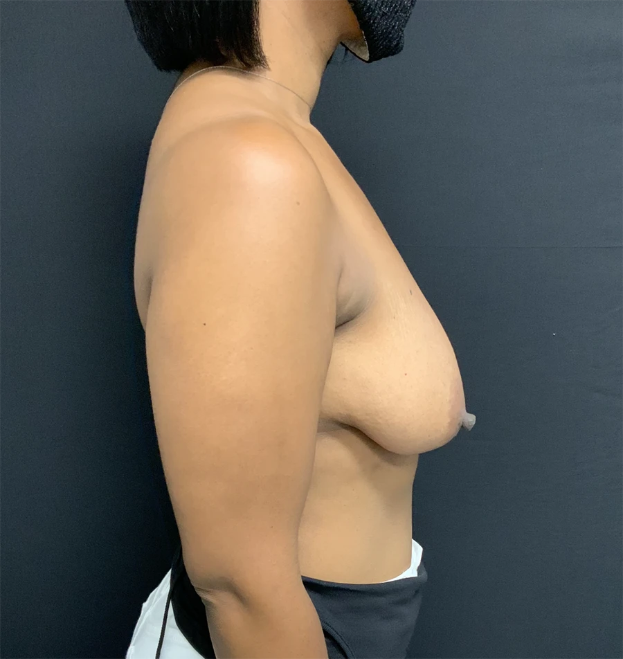 Breast Augmentation with Lift