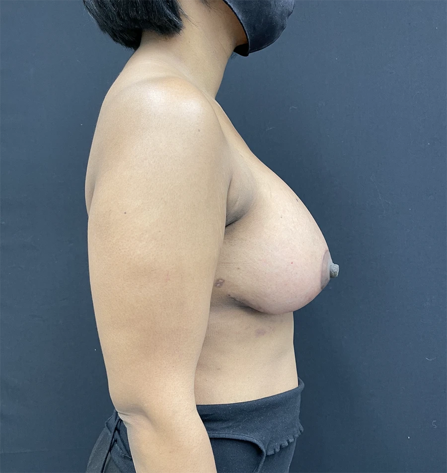 Breast Augmentation with Lift