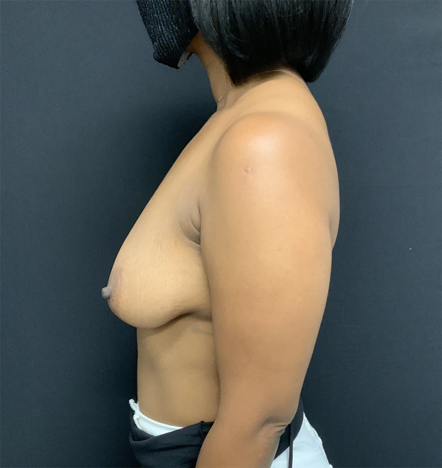 Breast Augmentation with Lift