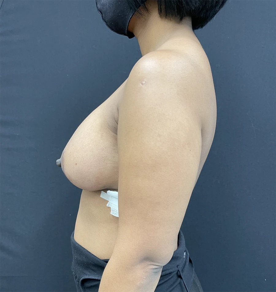 Breast Augmentation with Lift