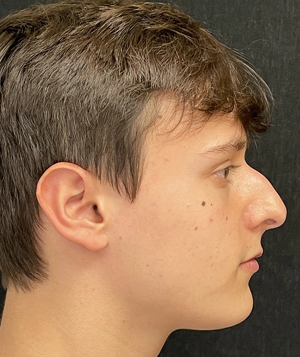 Rhinoplasty