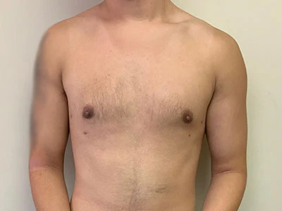 Gynecomastia