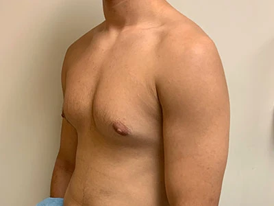 Gynecomastia