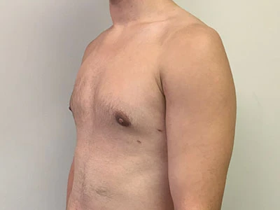 Gynecomastia