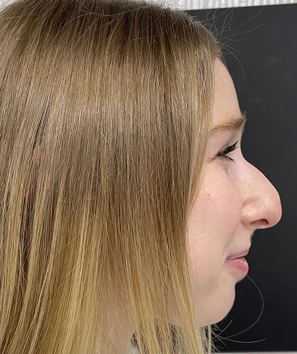 Rhinoplasty