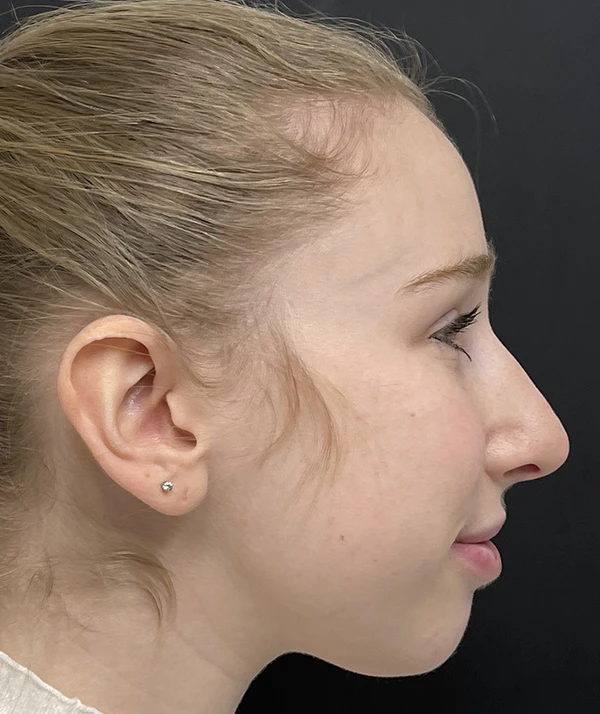 Rhinoplasty