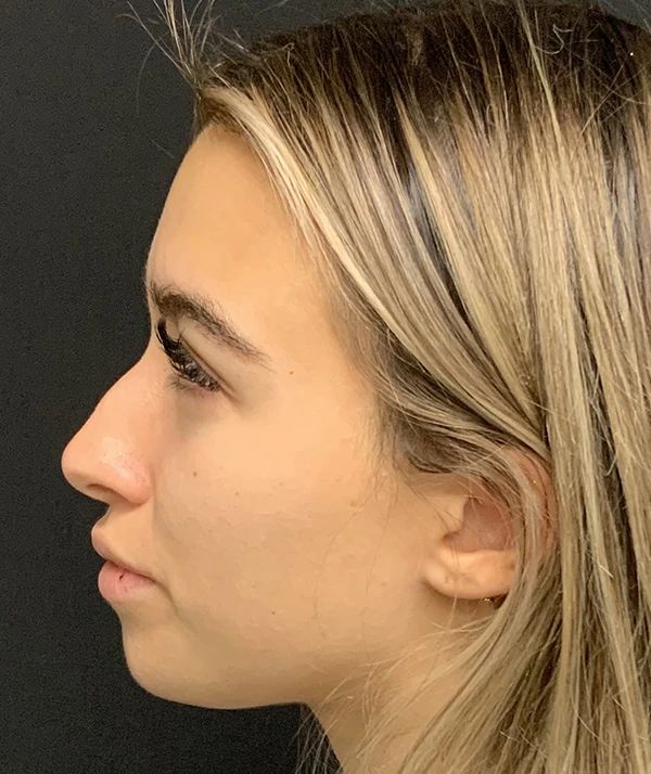 Rhinoplasty