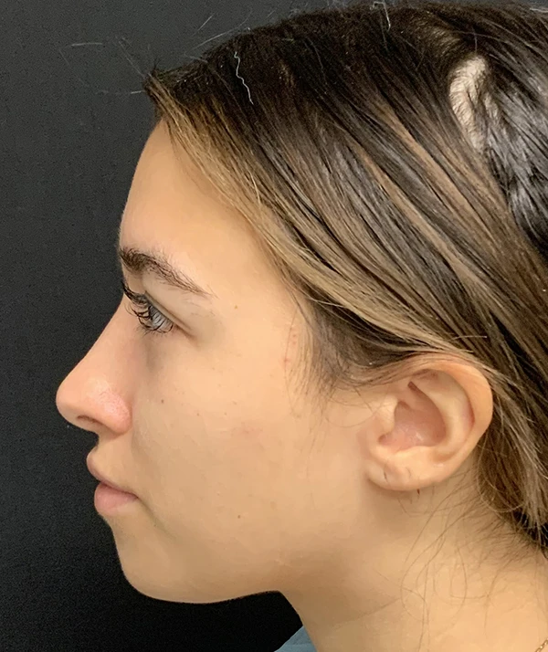 Rhinoplasty