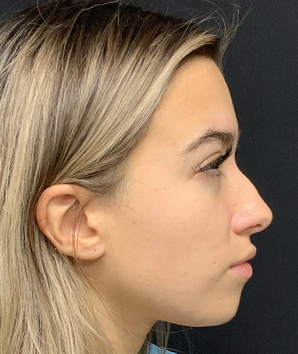 Rhinoplasty