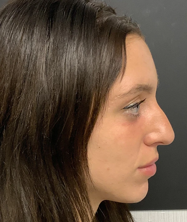 Rhinoplasty