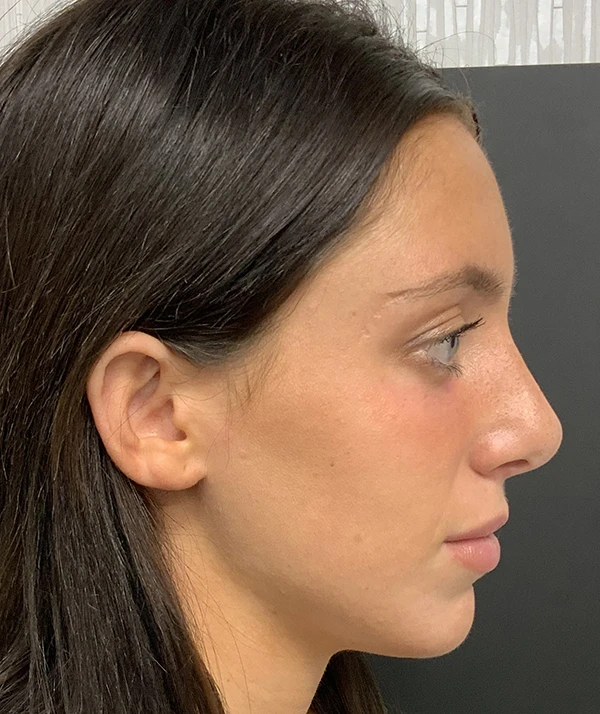 Rhinoplasty