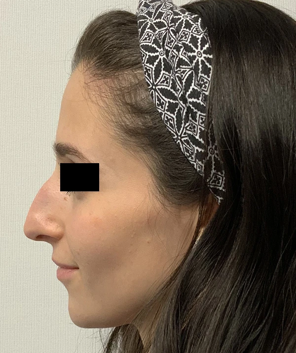 Rhinoplasty