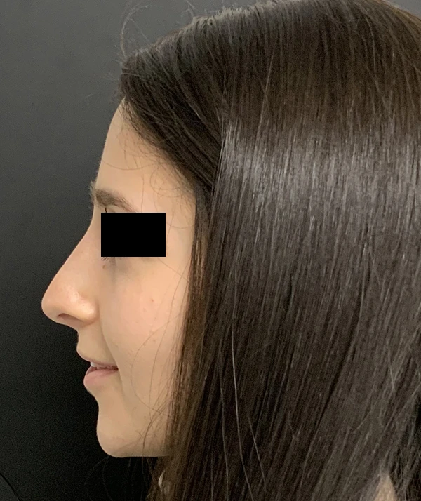 Rhinoplasty