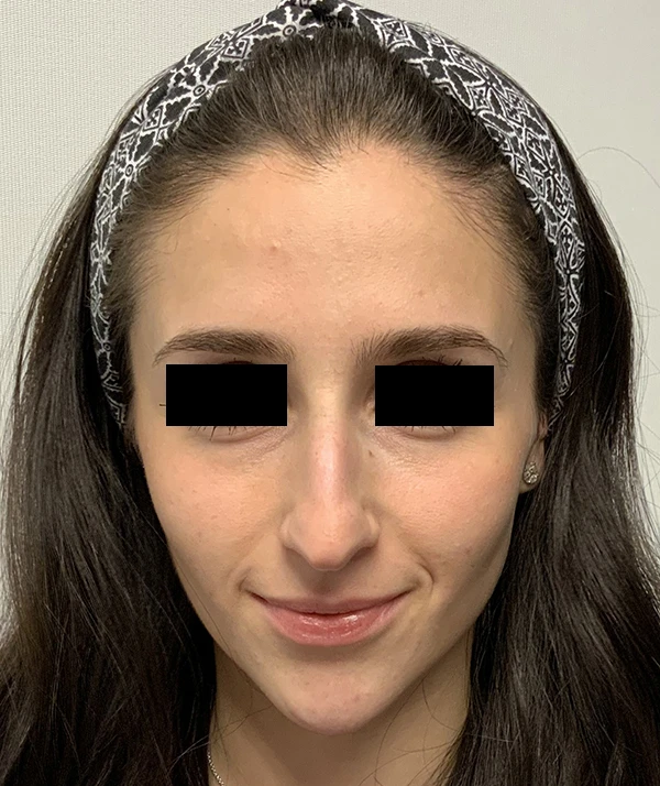 Rhinoplasty