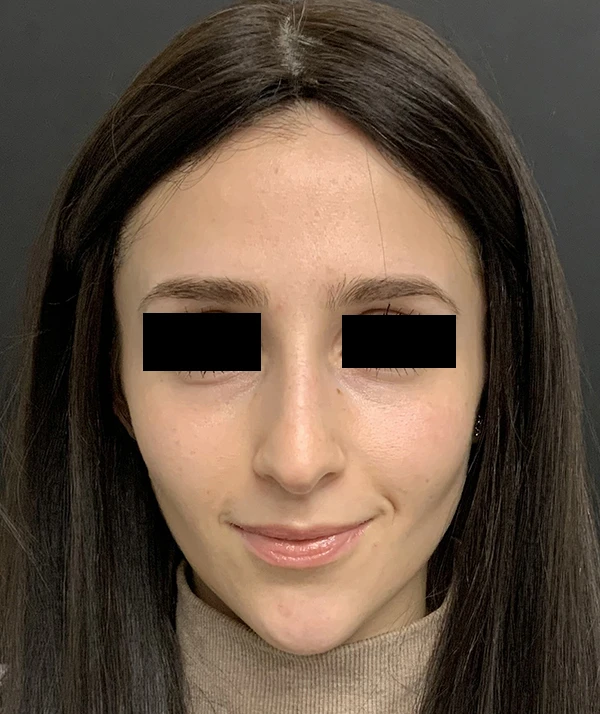 Rhinoplasty