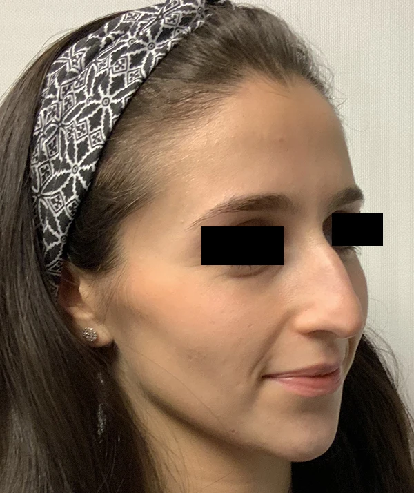 Rhinoplasty