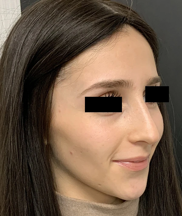 Rhinoplasty