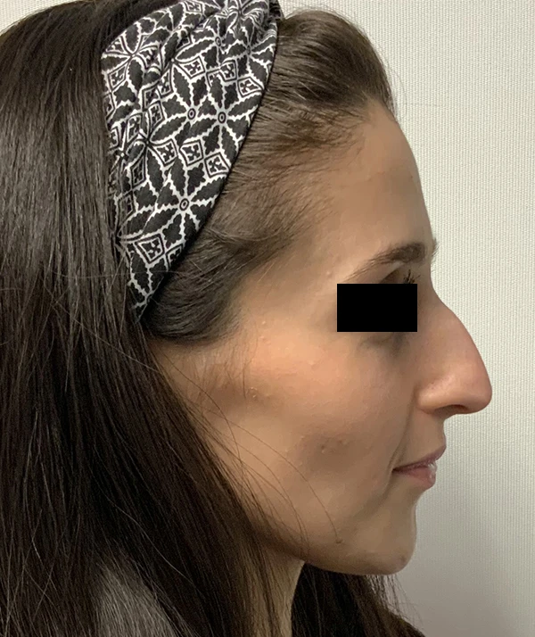 Rhinoplasty