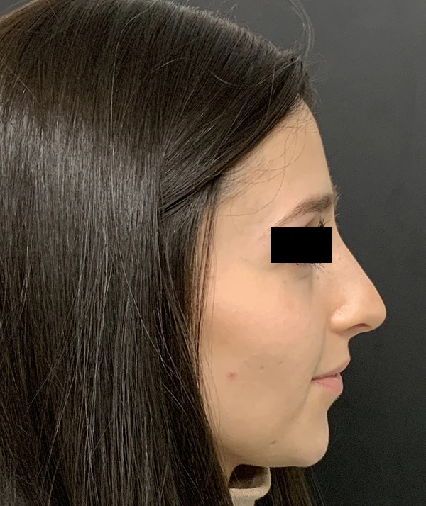 Rhinoplasty