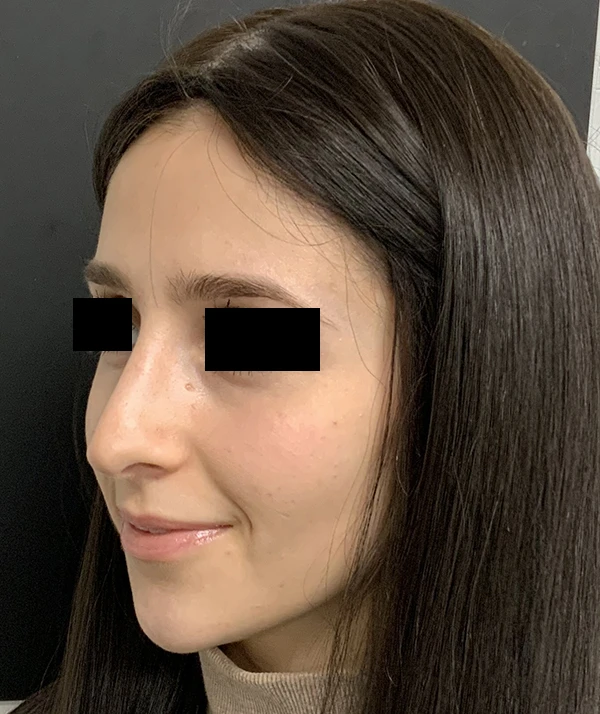 Rhinoplasty