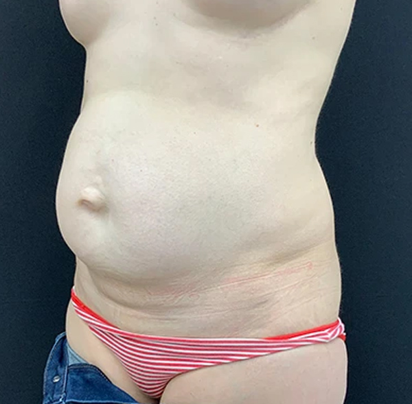 Tummy Tuck