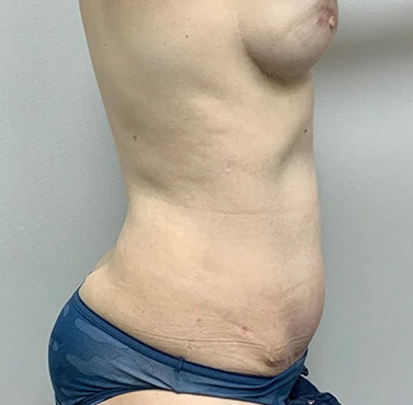 Tummy Tuck