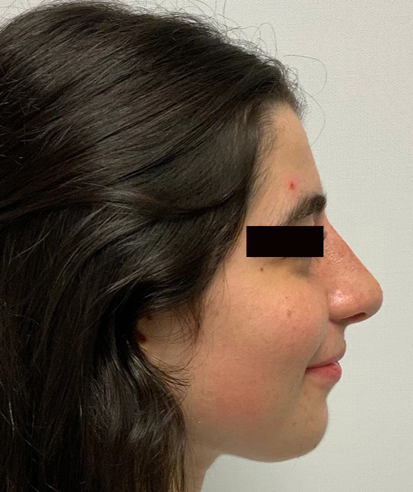 Rhinoplasty