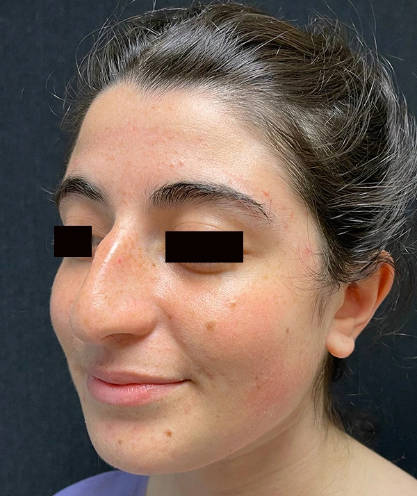 Rhinoplasty