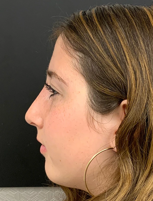 Rhinoplasty