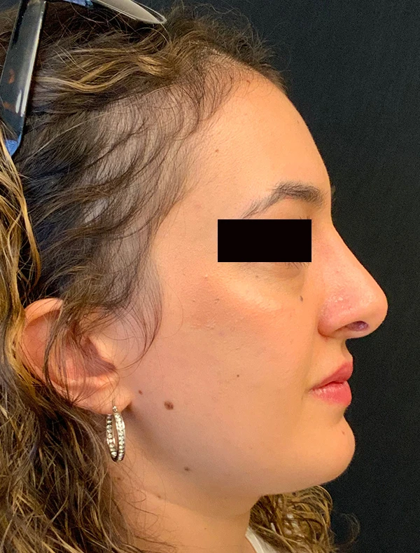 Rhinoplasty