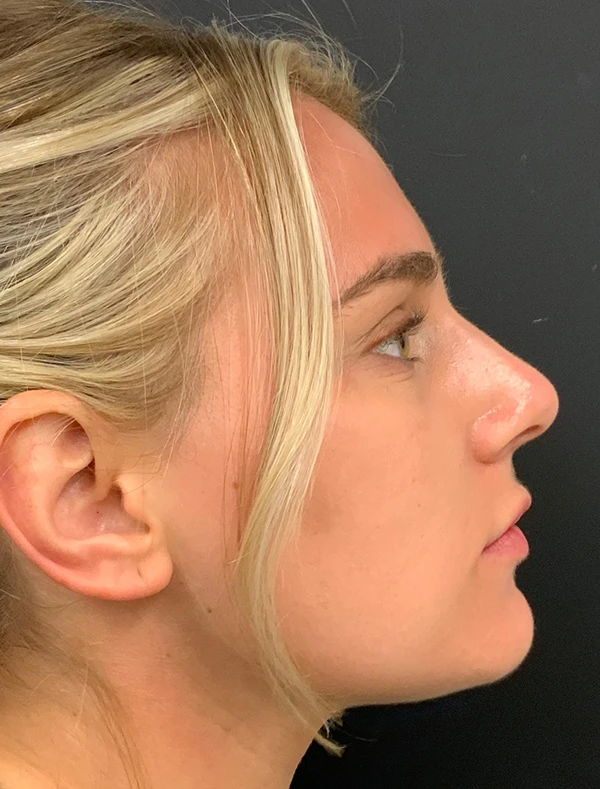 Rhinoplasty